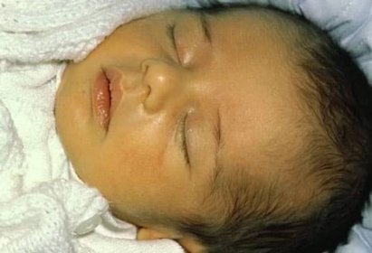 Neonatal or Newborn Jaundice