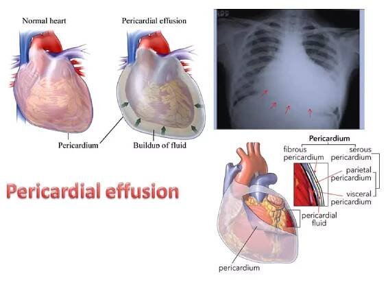 Pericardial effusion