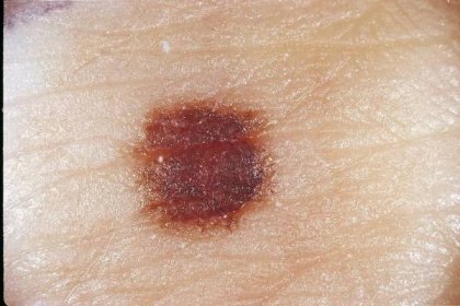 Rakovina kůže: důležité je nepropásnout počáteční stadium!