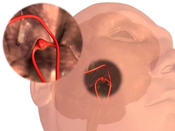 Aneurysma mozkové tepny. Zdroj fotografie: Getty images