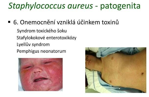 PPT - Gram pozitivní aerobní a fakultativně anaerobní bakterie PowerPoint Presentation - ID:6113005