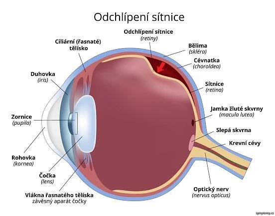 Odchlípení sítnice (retiny)