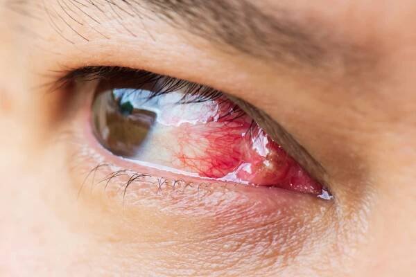 pterygium během očního vyšetření. koncepce zdravotní péče. - rohovka - stock snímky, obrázky a fotky