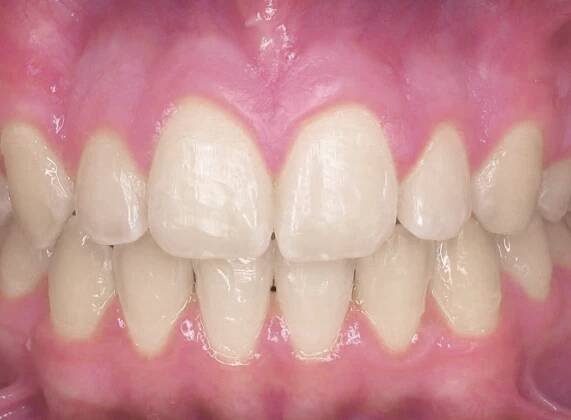 Smile Gallery - Zaytoun Orthodontics
