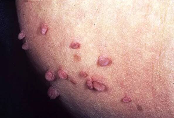 Picture of Skin Tag
