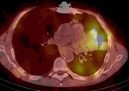 Obr. č. 14: Fúze obrazů SPECT a CT – vyšetření hrudníku. Vyšetření 24 hod. po aplikaci radiofarmaka. Transverzální řez.