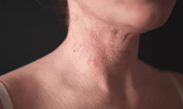 Understanding and Treating Eczema: Insights from Dr. Noah Gratch at MDCS Dermatology