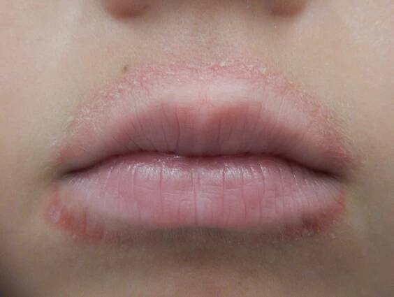 Periorální dermatitida - 10 zaručených přírodních léků