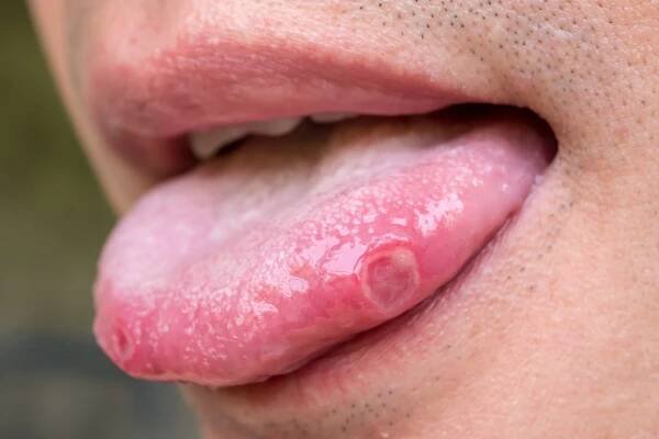 Trápí vás afty, vřídky nebo opary v ústech? :: TOP-DENT Vše pro dentální hygienu
