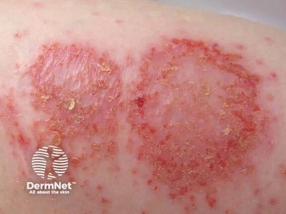 Dermatitis. Nummular dermatitis