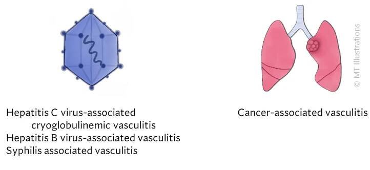 Types of Vasculitis : Johns Hopkins Vasculitis Center