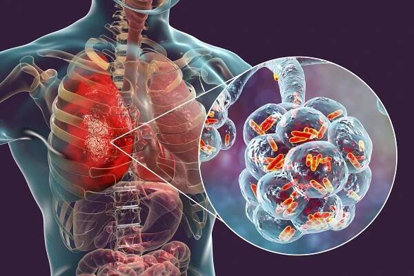 Začíná podzimní vlna očkování proti pneumokokům. Děti a senioři jej mají zdarma