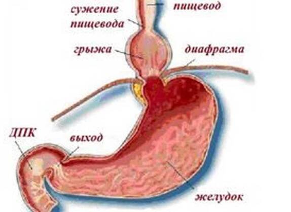 Hernie jícnu / Hernia
