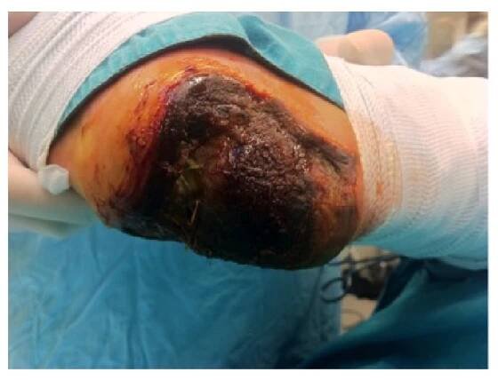 Full thickness necrosis of the heel due to acute limb ischemia