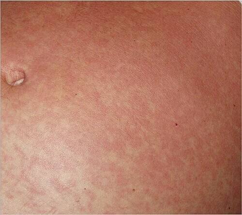 Typical fine-spotted pink rash of acute African trypanosomiasis on the skin of the abdomen ("trypanid rash")[15]