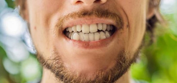 Jak přestat skřípat zuby: S bruxismem pomáhá botulotoxin i jóga