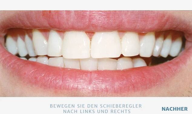 Bleaching