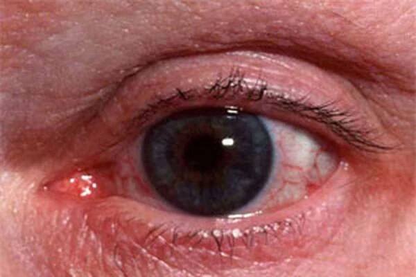 Rosacea se podívá, co dělat? / Rosacea