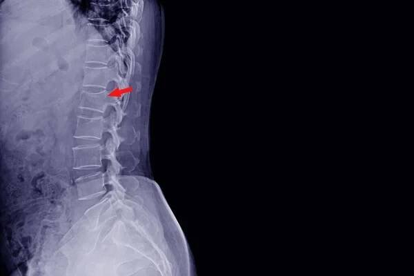 X-ray Boční zobrazení páteře anamnéza mužské nehody a černá bolest ukazuje kompresi zlomenina páteře L1. Normální diskové prostory a paravertebrální měkká tkáň.Lékařský koncept. — Stock obrázek