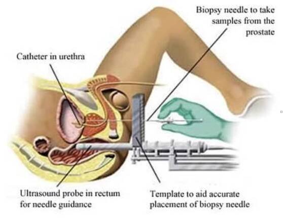 What is Nanoknife IRE - Prostaterisk.ca