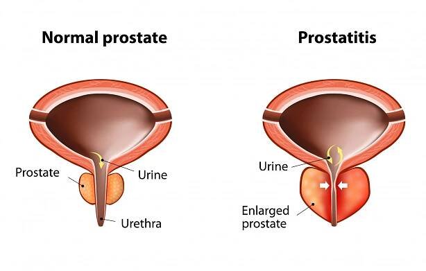 Prostatitida: příčiny, příznaky a příznaky, diagnostika, léčba