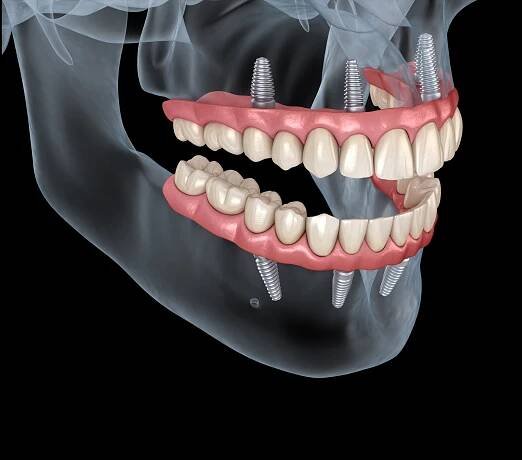 Maxilární a Mandibulární protéza s gumou Vše na 4 systému podporované implantáty. Lékařsky přesná 3D ilustrace lidských zubů a zubů — Stock obrázek