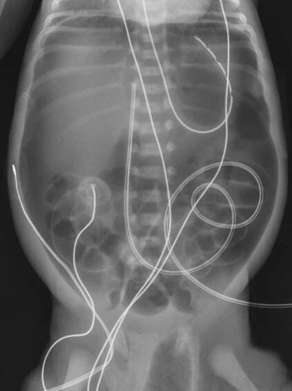 Spontaneous Intestinal Perforation | Applied Radiology