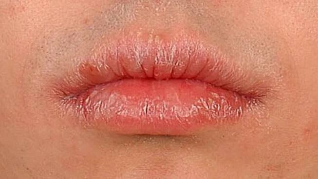 Cheilitis simplex
