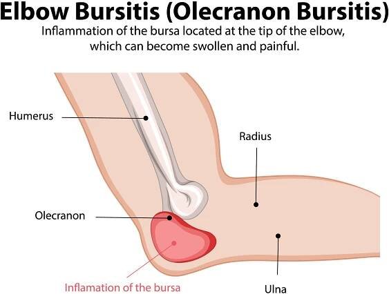 bursitida