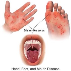 HFMD - Syndrom ruka – noha – ústa