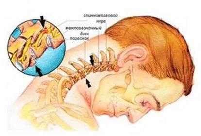Zacvaknutí nervu krční páteře / Zacvaknutý nerv