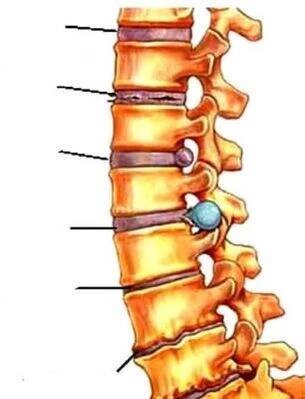 Osteochondróza