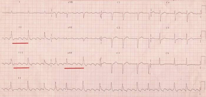Flutter síní - EKG | Medicína, nemoci, studium na 1. LF UK