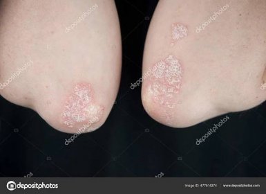Akutní Psoriáza Loktech Autoimunitně Nevyléčitelné Dermatologické Kožní Onemocnění Velká Červená
