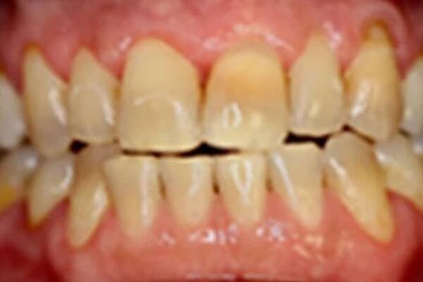 Seeing is Believing - Amazing KöR Whitening Results