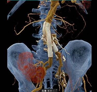CT angiografie břicha – stentgraft (cévní protéza), transplantovaná ledvina, uzavřený ilikofemorální bypass (přemostění uzavřeného úseku na tepně)
