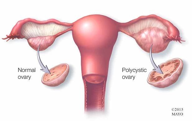 PCOD/PCOS-Srishti fertility and IVF centre in Jaipur