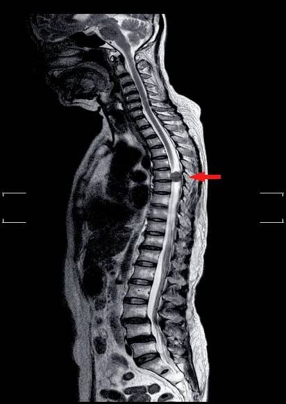 Mri Ti páteř — Stock obrázek