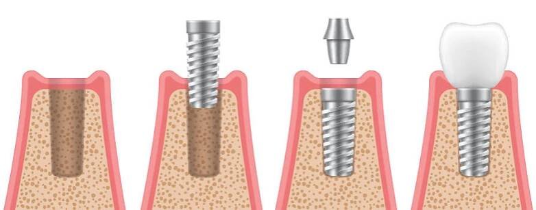 Za jak dlouho po vytržení zubu implantát