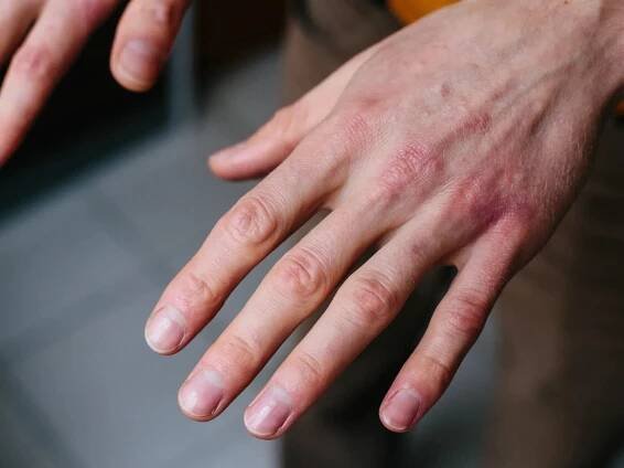 30 Facts About Leukoencephalopathy Palmoplantar Keratoderma