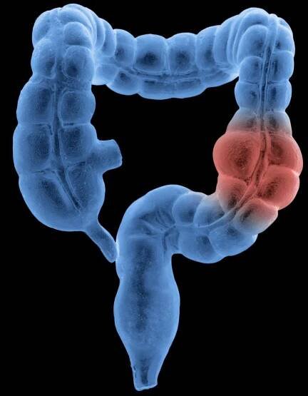 Report shows ‘troubling’ rise in colorectal cancer among US adults younger than 55