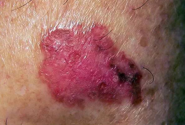 Picture of Squamous Cell Carcinoma (Calf)