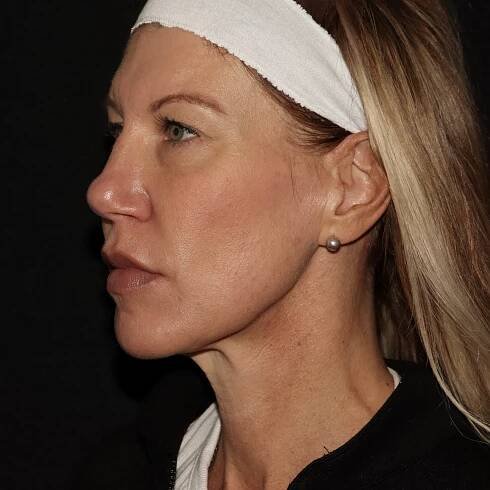 SR After Emface. Non-surgical facelift. mini facelift. needle free face lift. dermatology of the rockies. longmont. Boulder. Erie. Best medical spa near me.