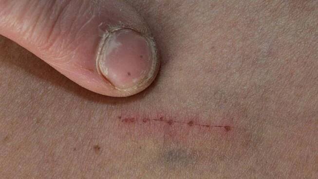 Tajuplný syndrom Morgellons. Když lidé vidí v kůži parazity - AAzdraví.cz