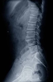 Snímek X-ray L-S pohled z boku páteře ukazuje kompresní frakturu L1 páteře. Koncept lékařského obrazu. — Stock obrázek