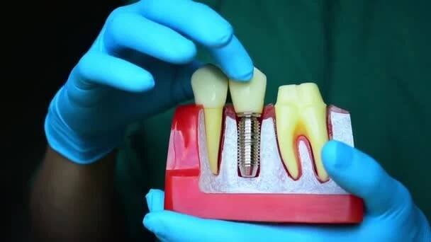 Detailní fotografie implantátu zubního lékařství je náhrada za chybějící zuby rukou zubaře. — Stock záběr