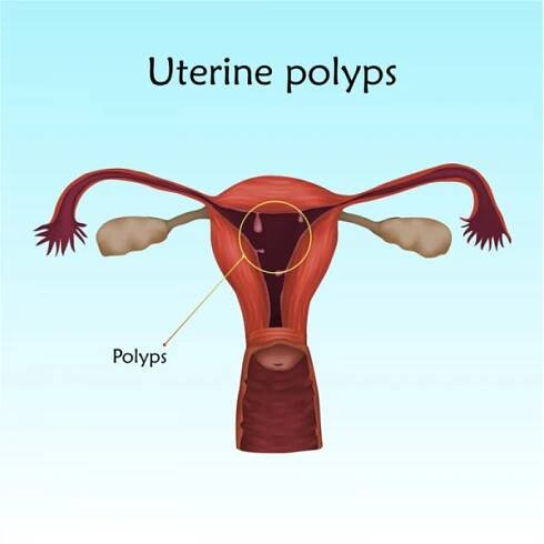 Děložní polyp