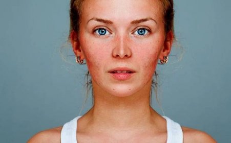 Co způsobuje růžovku na obličeji? Jak se k tomu chovat