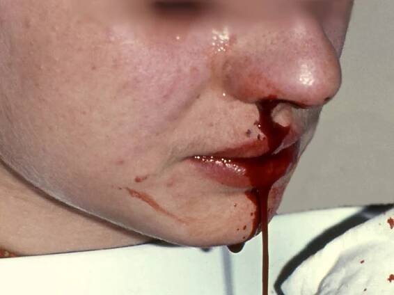 Epistaxe