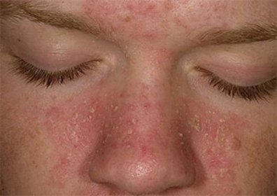 Seboroická dermatitida na obličeji